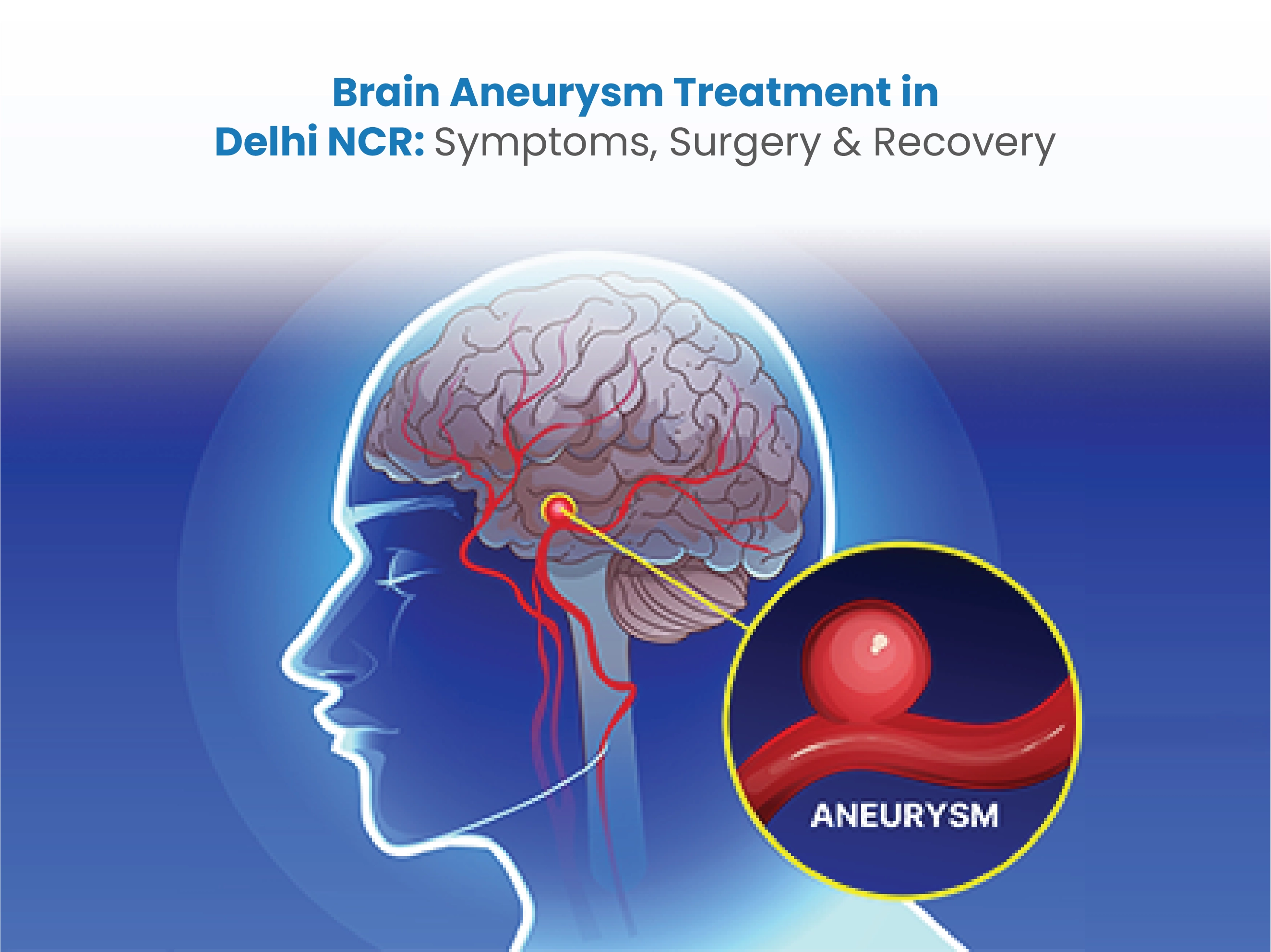 Brain Aneurysm Treatment in Delhi NCR: Symptoms, Surgery & Recovery
